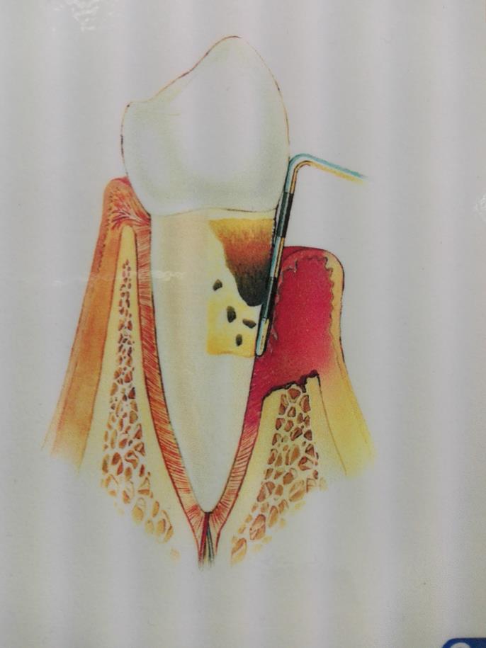 Parodontitis-Zahnfleischerkrankung